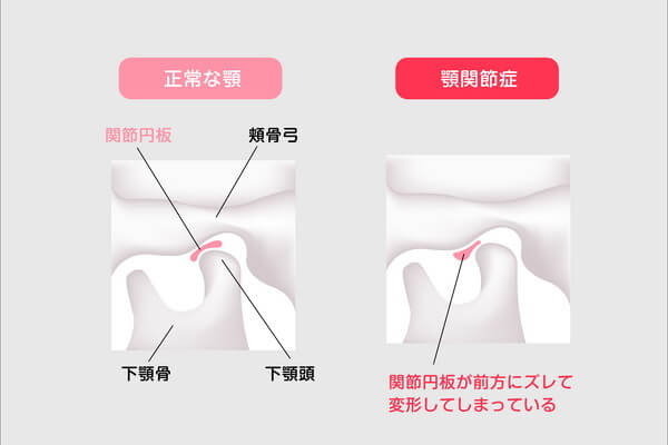 顎関節症の図解