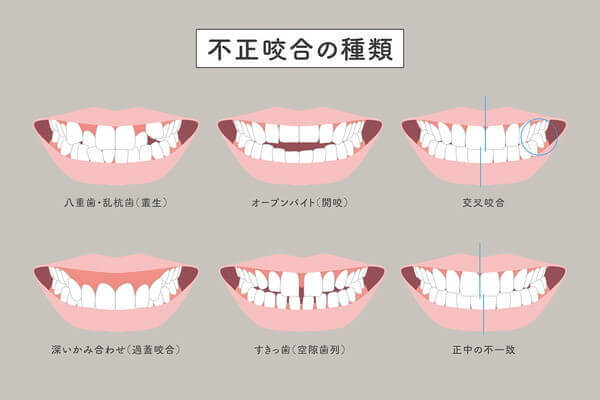 不正咬合の種類