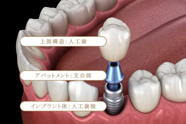 インプラントパーツの説明図