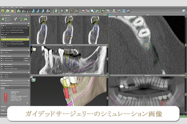 ガイデットサージェリーのシミュレーション画像例