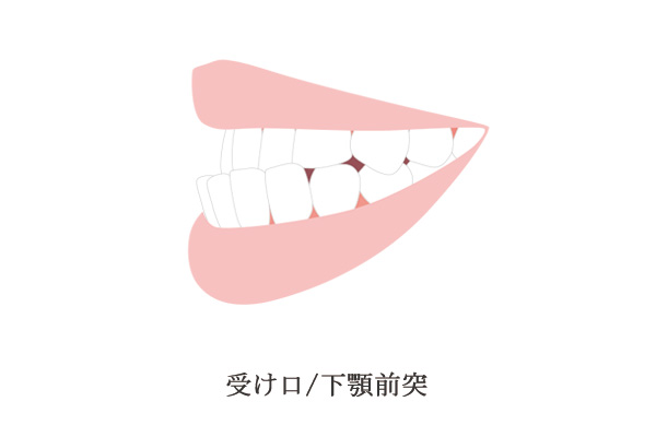 下顎前突のイメージ画像