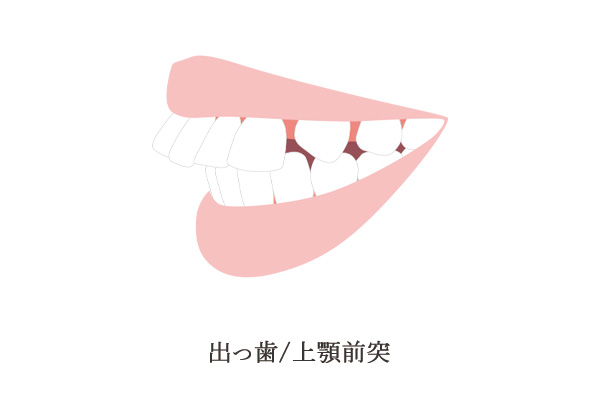 上顎前突のイメージ画像