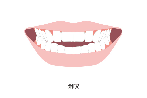 開咬のイメージ画像