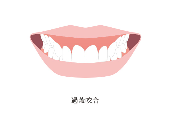 過蓋咬合のイメージ画像