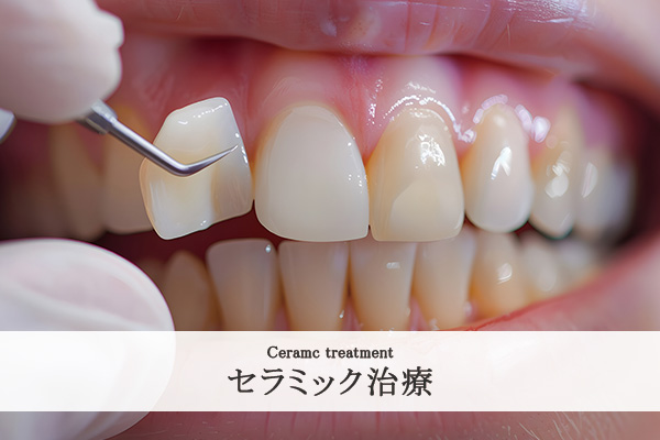 セラミック治療のイメージ画像
