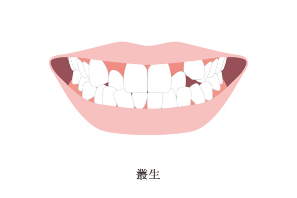 叢生のイメージ画像